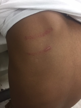 Jomaury Champ’s parents say these injuries across their son’s back were the result of a beating arranged by his 4th grade teacher
